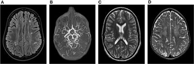 Genetic Testing Contributes to Diagnosis in Cerebral Palsy: Aicardi-Goutières Syndrome as an Example